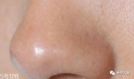 小气泡是什么 小气泡去黑头有效吗 小气泡是什么 小气泡去黑头有效吗