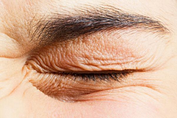 眼部细纹可以热敷吗 眼部细纹能淡化吗 眼部细纹可以热敷吗 眼部细纹能淡化吗