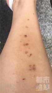 ​女子激光脱毛被灼伤 面部毛发越脱越多