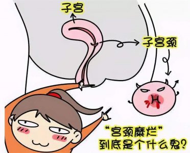 ​宫颈糜烂能自己痊愈吗 宫颈糜烂能自行恢复吗?