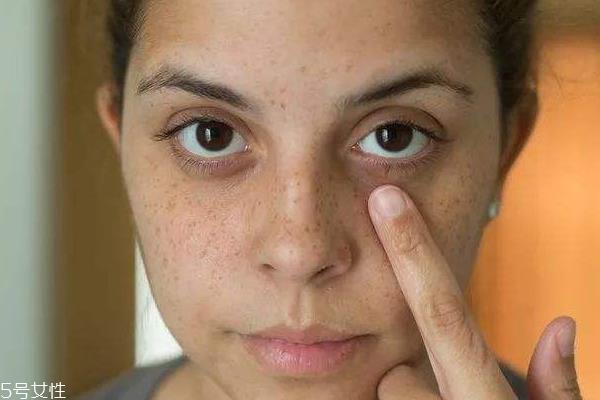 晒后多久会变黑 3天后皮肤就会变黑 晒后多久会变黑 3天后皮肤就会变黑