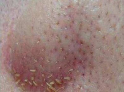 ​从脸上挤出的黄白色粒粒是什么